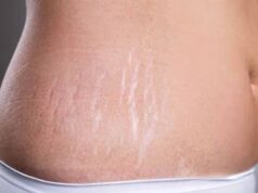 घर बैठे ऐसे मिटाएँ जिद्दी स्ट्रेच मार्क्स, बिना महंगे इलाज के